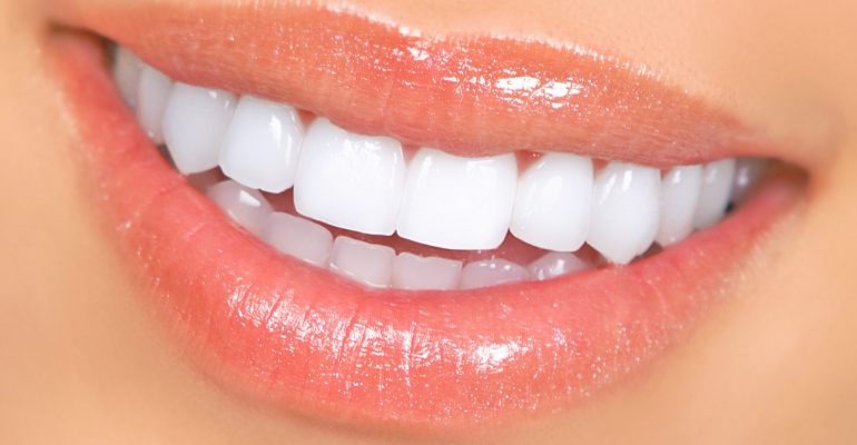 Professional Tooth Whitening Professional Tooth Whitening Smile