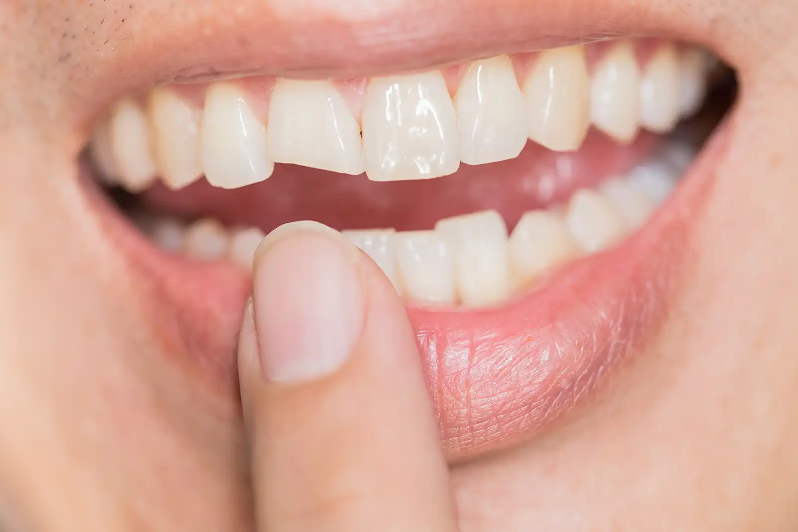 chipped tooth dental emergency Chipped Tooth Dental Emergency