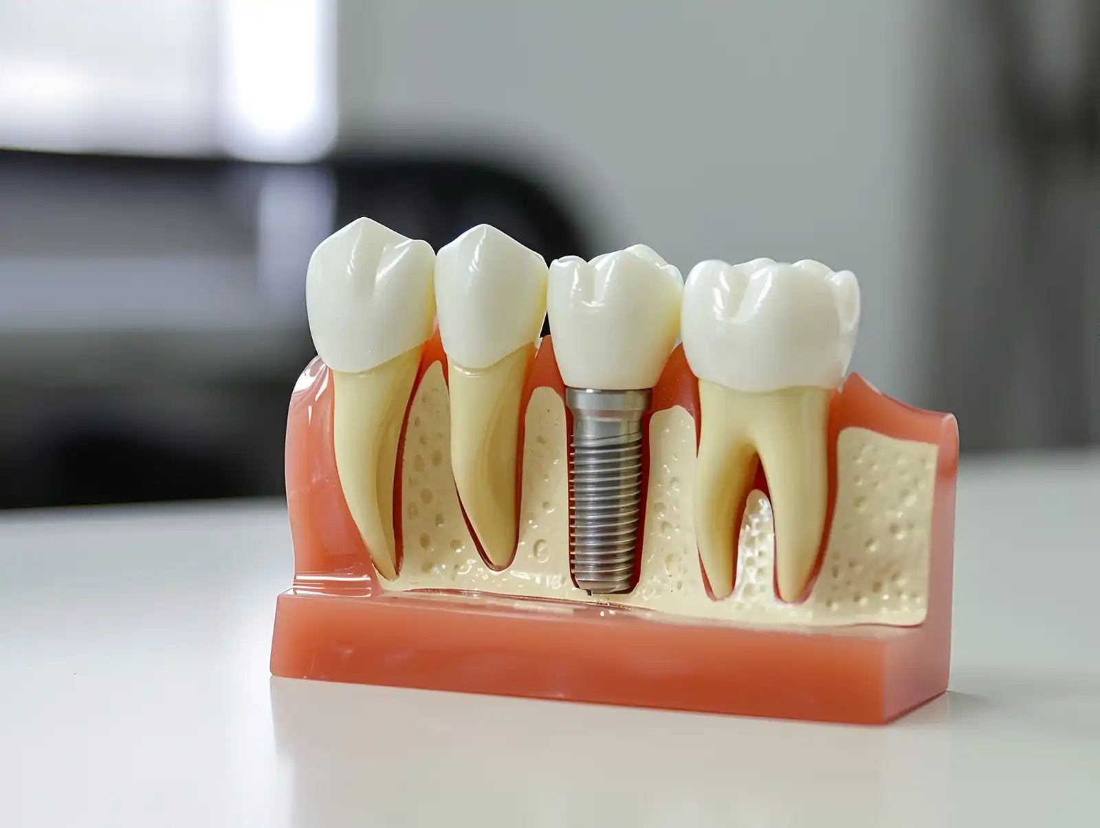 dental implants durability