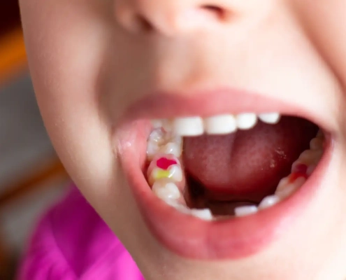 Loose fillings in a child