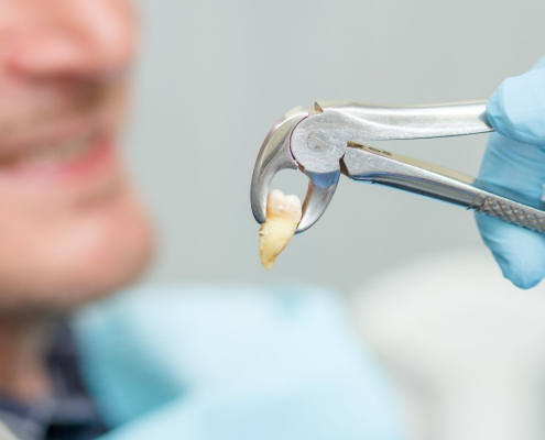 Tooth Post-Extraction.