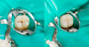 Sealants vs. Fillings