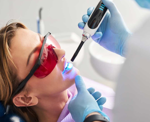 Sealants vs. Fillings