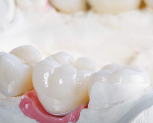 same-day dental crowns Hudson using Cerec technology.