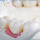 same-day dental crowns Hudson using Cerec technology.