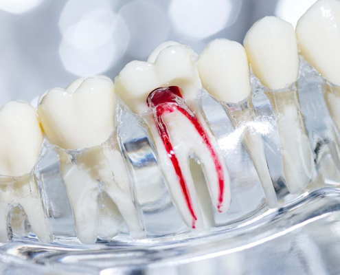 Image showing the inside root canal in a molar. Root Canal Therapy in Hudson, MA.