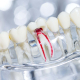 Image showing the inside root canal in a molar. Root Canal Therapy in Hudson, MA.