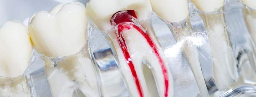 Image showing the inside root canal in a molar. Root Canal Therapy in Hudson, MA.