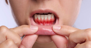 Clinical example of gingivitis triggered by hormonal gum issues.