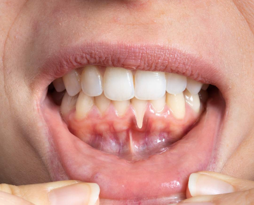 Picture of woman showing Hormonal Gum Issues.