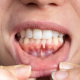 Picture of woman showing Hormonal Gum Issues.