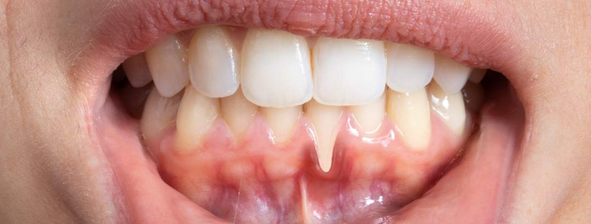 Picture of woman showing Hormonal Gum Issues.