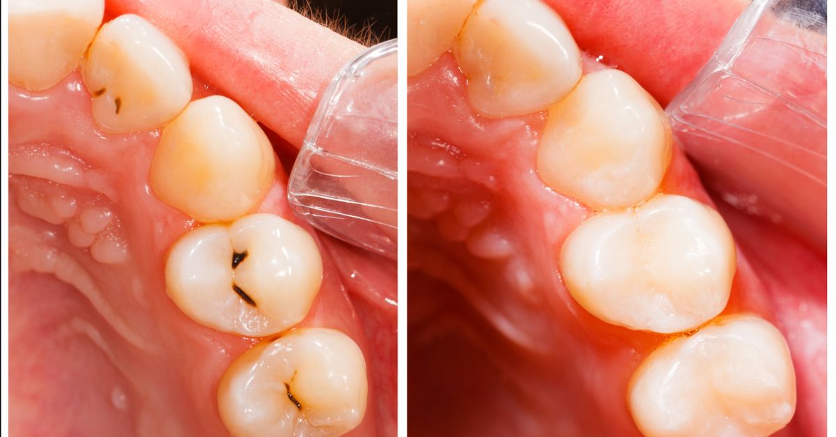 Side-by-side comparison of teeth with visible decay and teeth after professional dental cleaning or restoration.