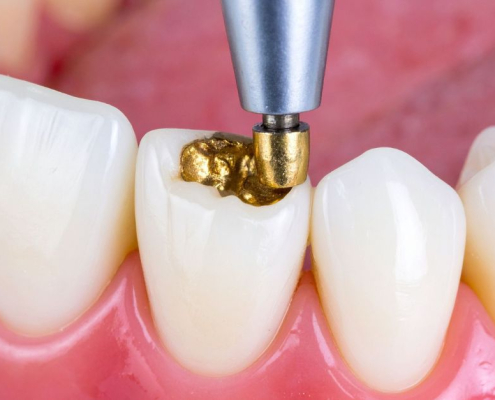 A dentist removing or replacing an old gold restoration on a patient's premolar, showcasing the expert care provided for Dental Filling Replacements in Hudson.