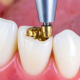 A dentist removing or replacing an old gold restoration on a patient's premolar, showcasing the expert care provided for Dental Filling Replacements in Hudson.