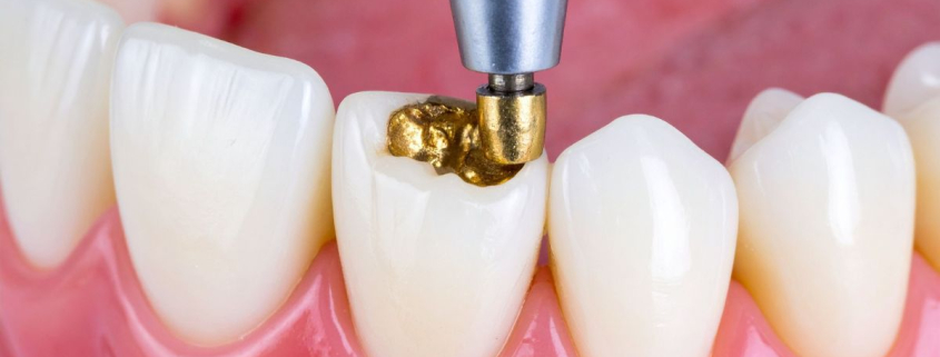 A dentist removing or replacing an old gold restoration on a patient's premolar, showcasing the expert care provided for Dental Filling Replacements in Hudson.